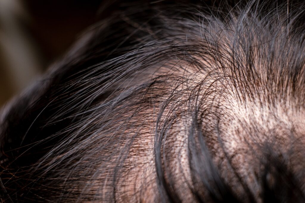 Un cuir chevelu touché par la perte de cheveux