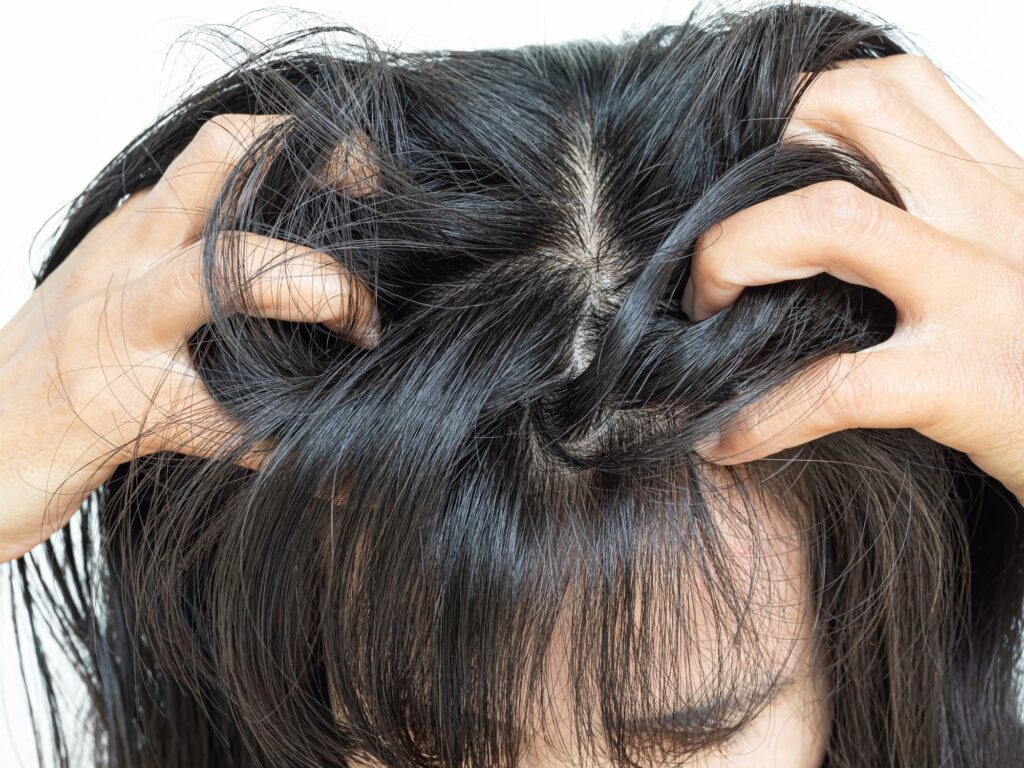 Pellicules cheveux cuir chevelu sébum femme gros plan, champignon peau démangeaison tête problème problème sale sec égratignure séborrhée, cheveux bruns asiatiques.