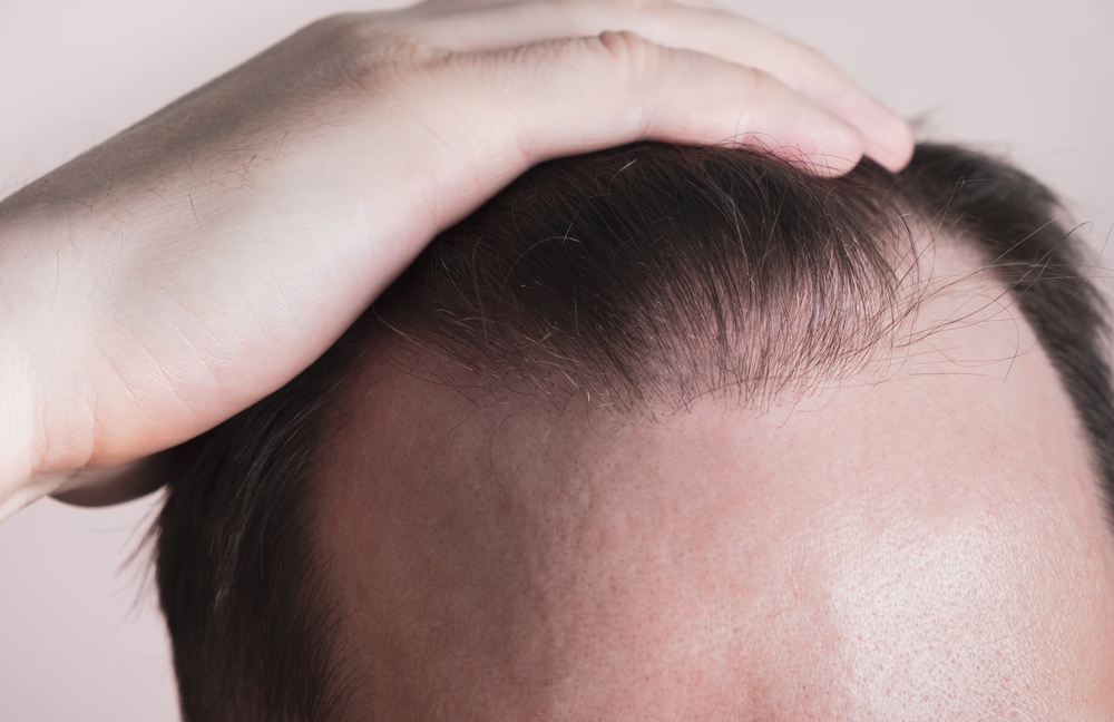 Perte de cheveux sur le devant du crâne chez la femme, que faire ?