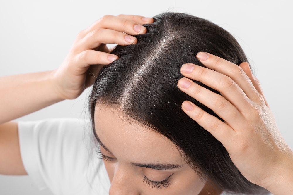 Pellicule après le lavage des cheveux : que faire ?