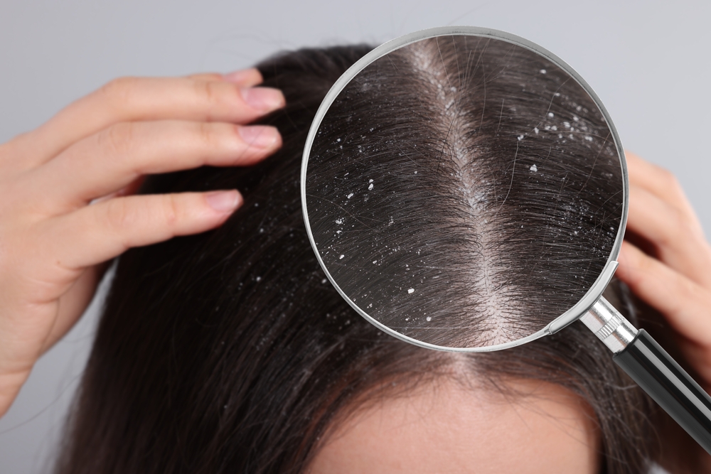 Cuir chevelu et pellicules : causes et solutions