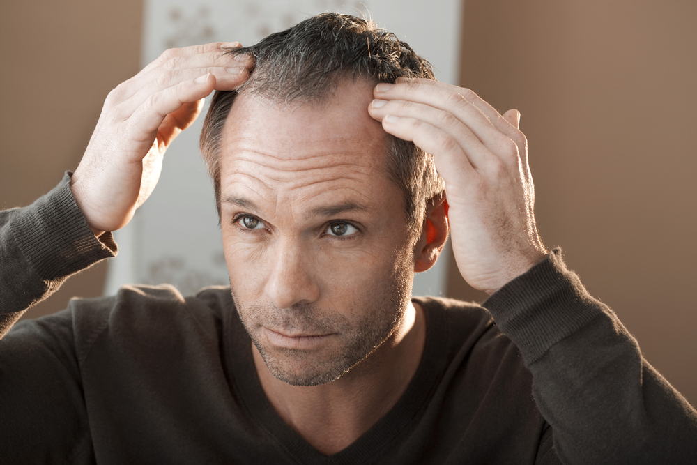 Perte de cheveux homme : le guide pour tout savoir