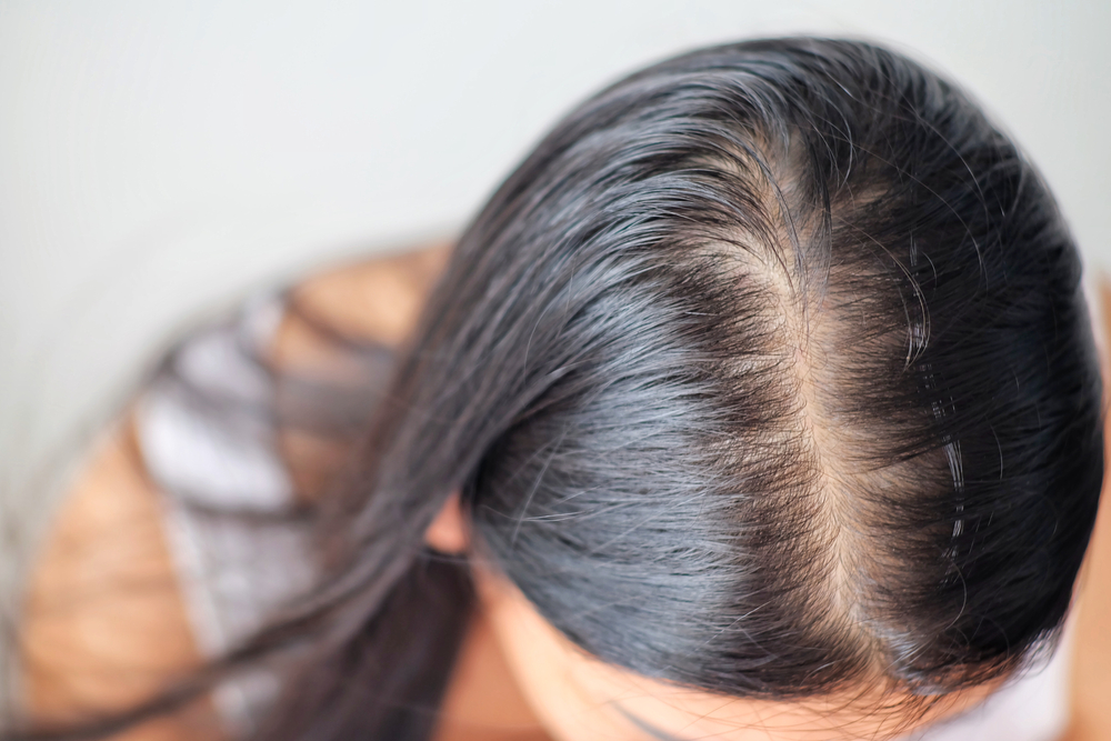 Cheveux clairsemés chez la femme : causes et solutions