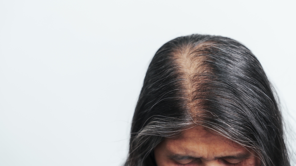 Chute de cheveux
