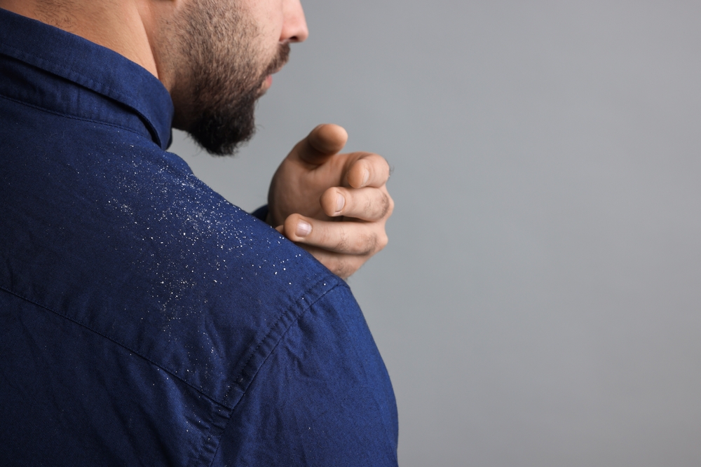 The main causes of dandruff in hair