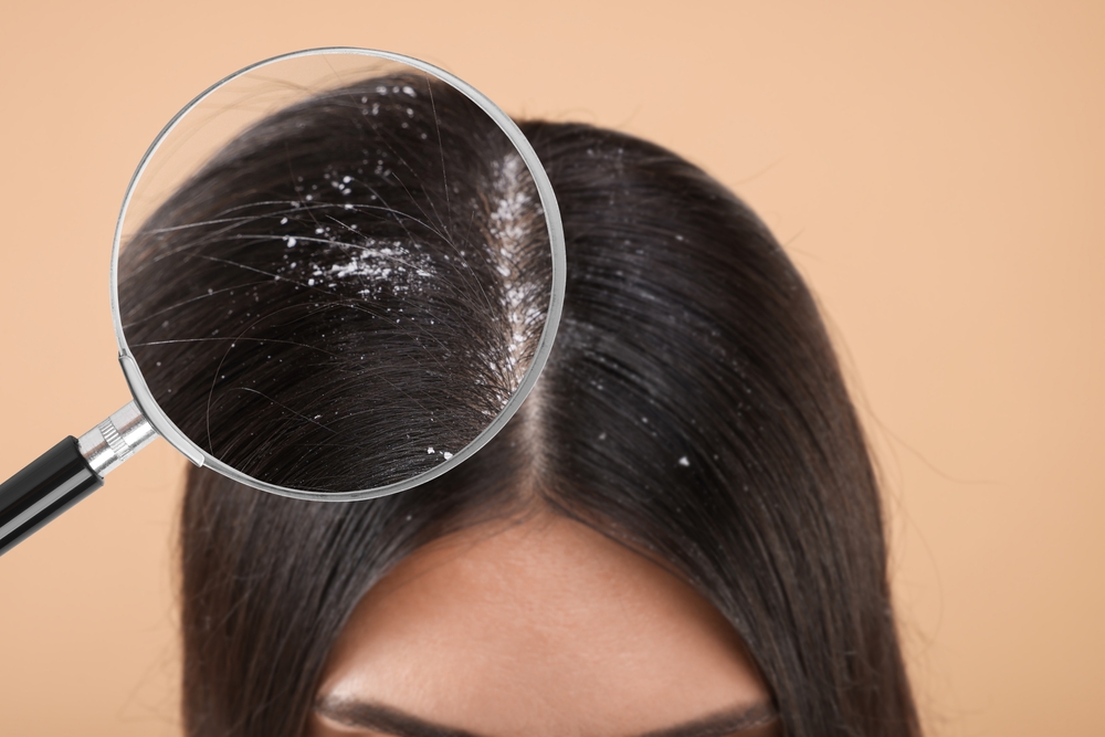 Pourquoi ai-je des pellicules dans les cheveux ?