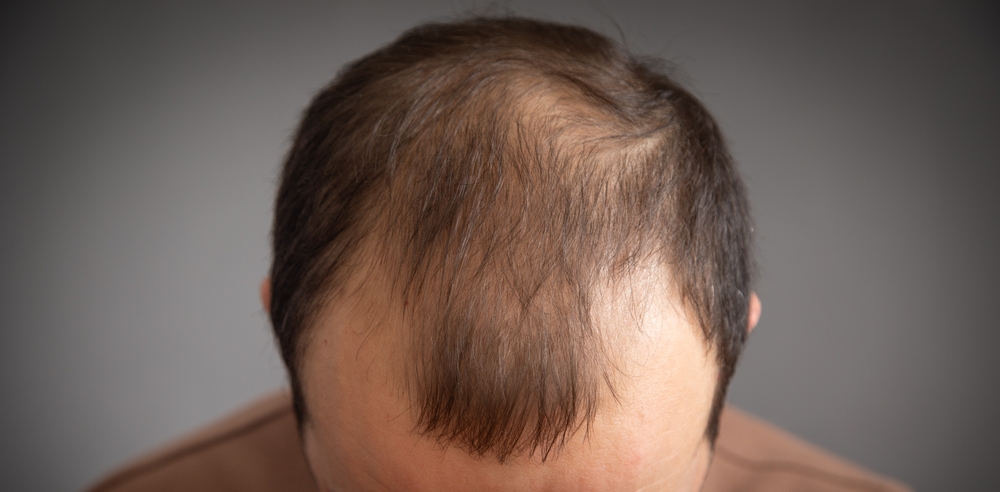 Perte de cheveux chez l'homme : les causes les plus fréquentes