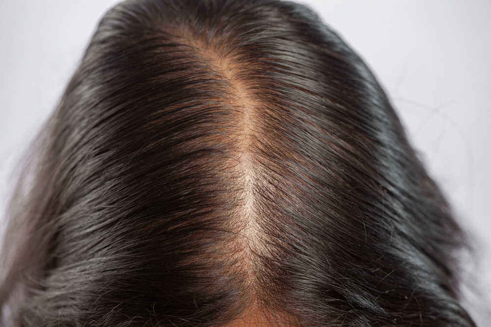 Quand s’inquiéter de la perte de cheveux ?