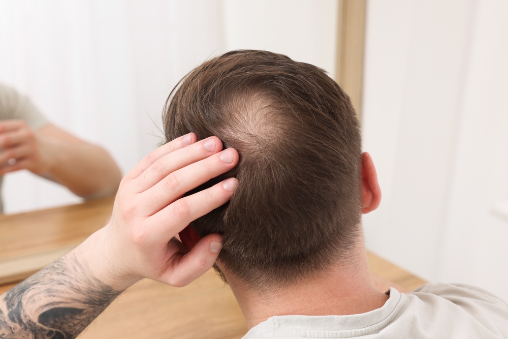 Perte de densité des cheveux : définition, explications et solutions