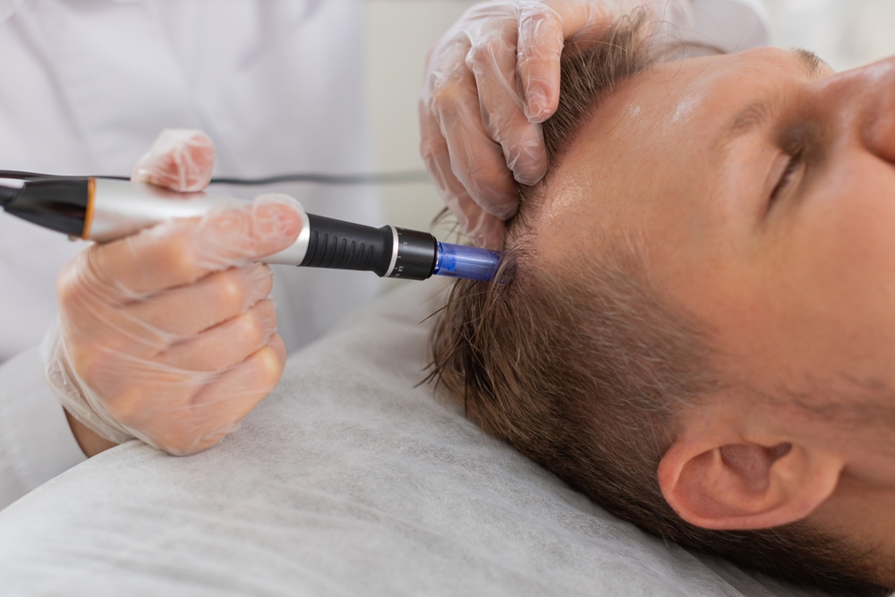 Microneedling capillaire : le guide complet