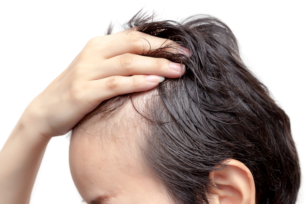 Perte de densité des cheveux : définition, explications et solutions
